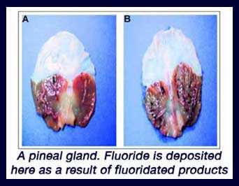[Image: calcified_pineal_gland.jpg]